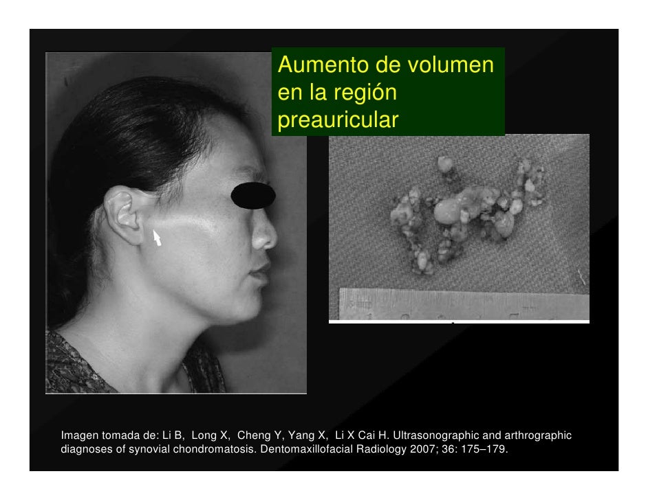 condromatosis sinovial